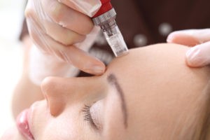 What Are the Benefits of Microneedling With a Dermapen? featured image